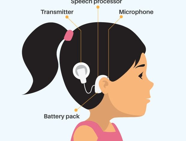 Cochlear Implant