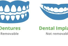 implant dentures dental