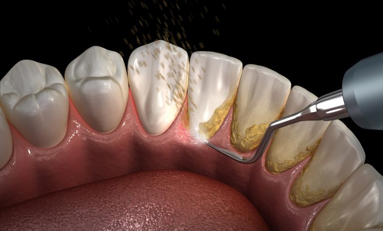 teeth cleaning