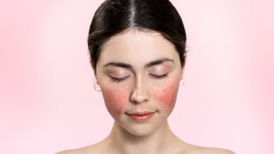treatment for rosacea flare-ups