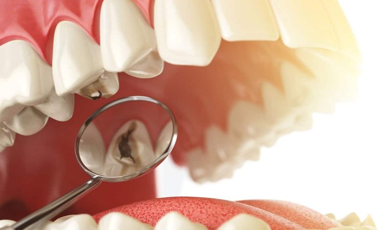 teeth root canal treatment